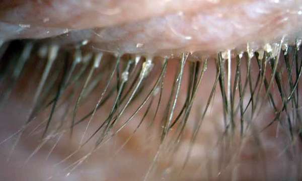 фото демодекозного блефарита глаз